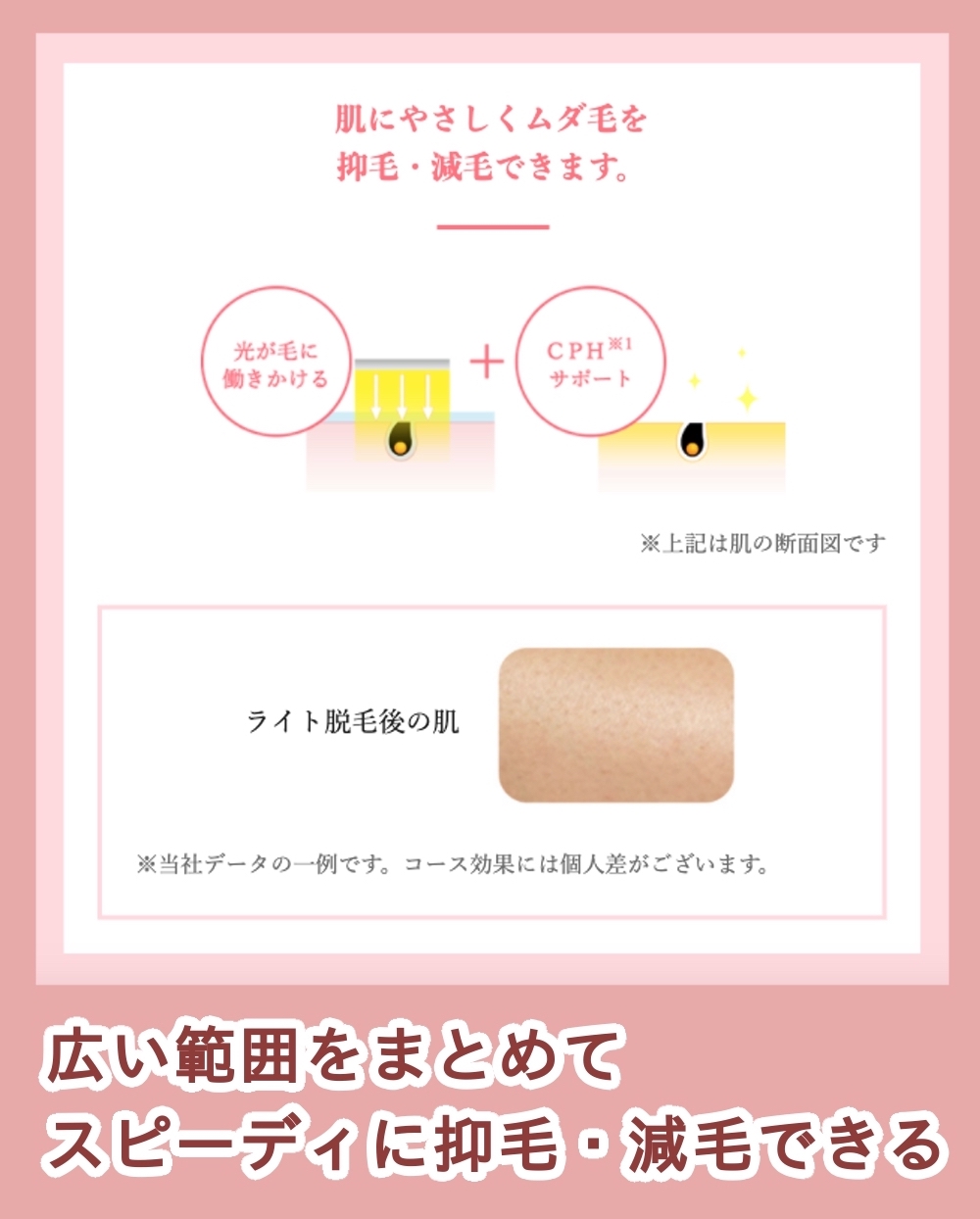 TBCライト脱毛(美容ライト脱毛)